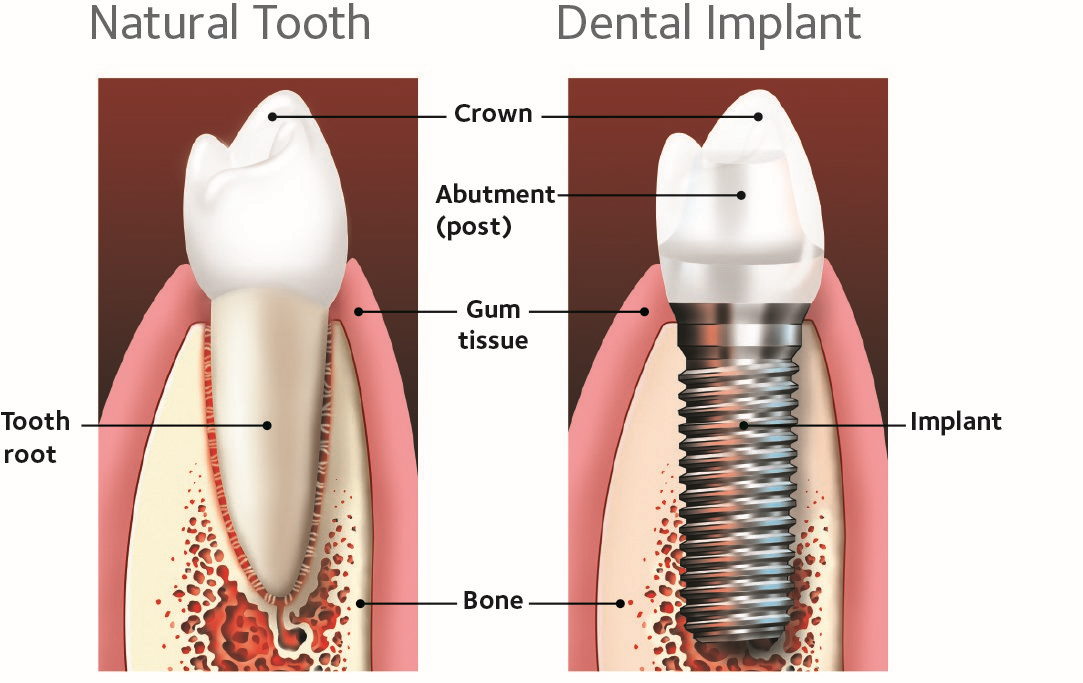 Dental Implants Manchester