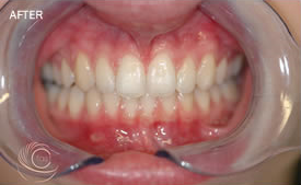 Teeth Straightening Manchester (after)