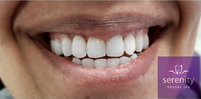 Teeth Straightening Manchester (after)