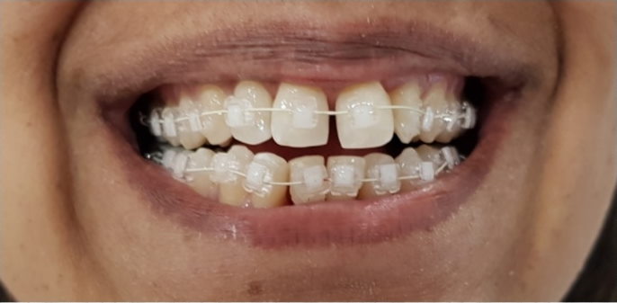Teeth Straightening Manchester (before)